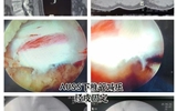 兰大二院急诊外科成功实施一例关节镜辅助单孔脊柱内镜技术微创手术（AUSS）